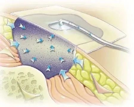 怎么促进vsd伤口愈合负压封闭引流术（VSD）：让伤口愈合更轻松_https://www.jmylbn.com_新闻资讯_第9张