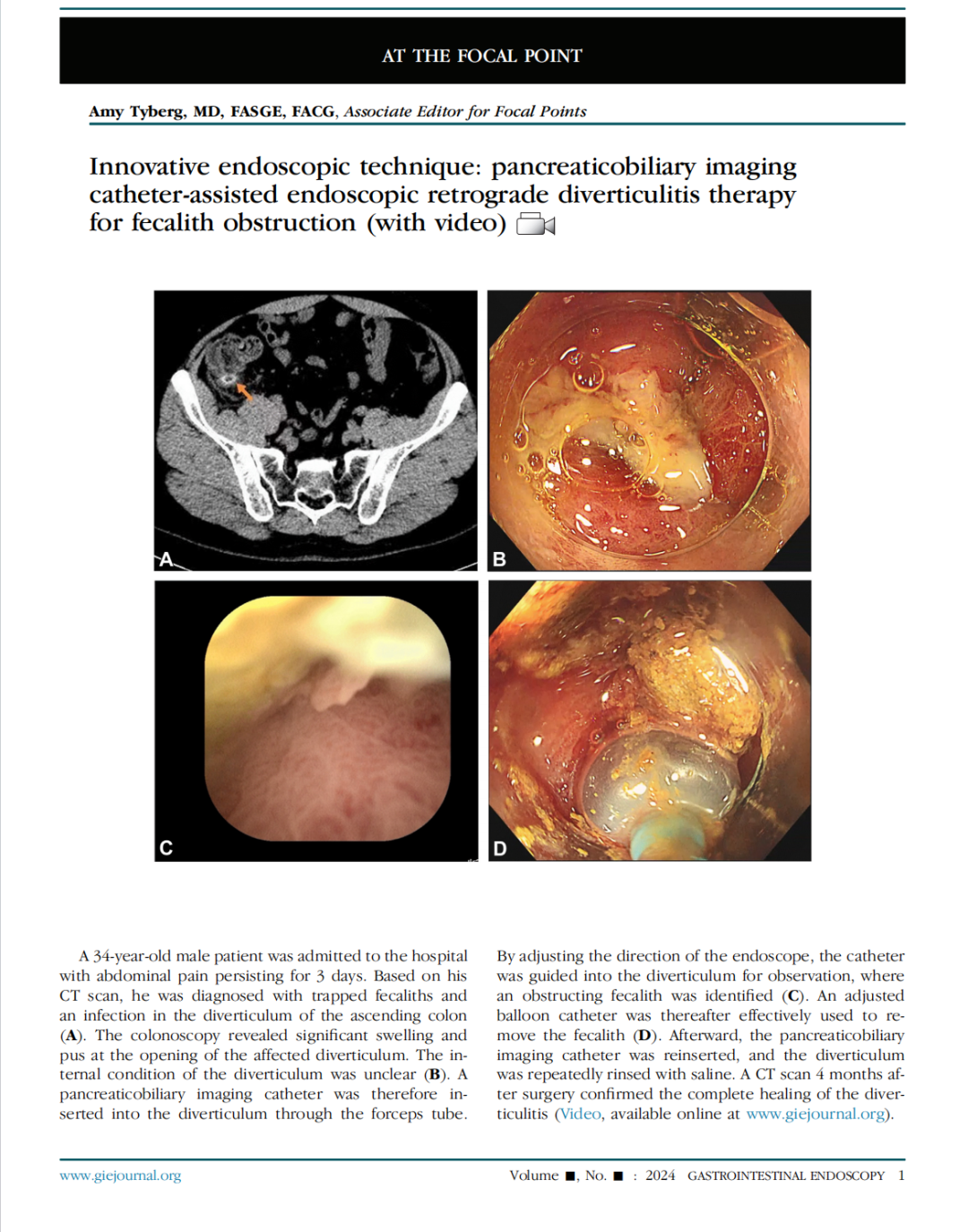 取石球囊怎么取石重大发表 ｜ 全球开创性突破！子镜引导下结肠憩室改良球囊取石术在消化与肝病TOP期刊在线发表_https://www.jmylbn.com_新闻资讯_第3张