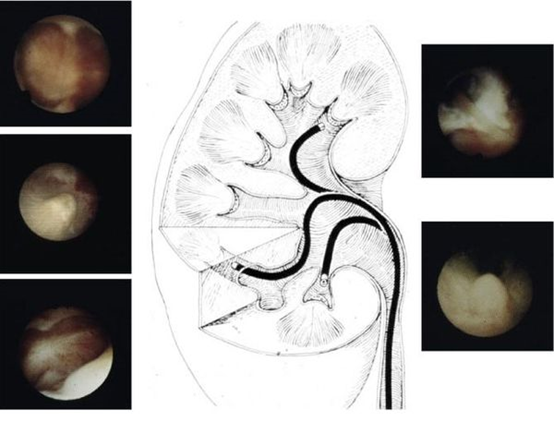 什么是输尿管镜什么是输尿管软镜碎石术？_https://www.jmylbn.com_新闻资讯_第7张