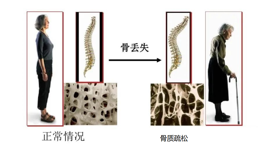 双能x骨密度检测仪为什么非得输入体重身高【健康科普】骨质疏松症早筛查，双能X线骨密度仪来助力_https://www.jmylbn.com_新闻资讯_第6张