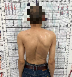 警惕脊柱侧弯，享健康人生