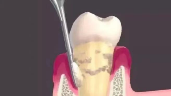 口腔内窥镜怎么用【口腔科普】牙周内窥镜：开启口腔健康的微观世界_https://www.jmylbn.com_新闻资讯_第4张