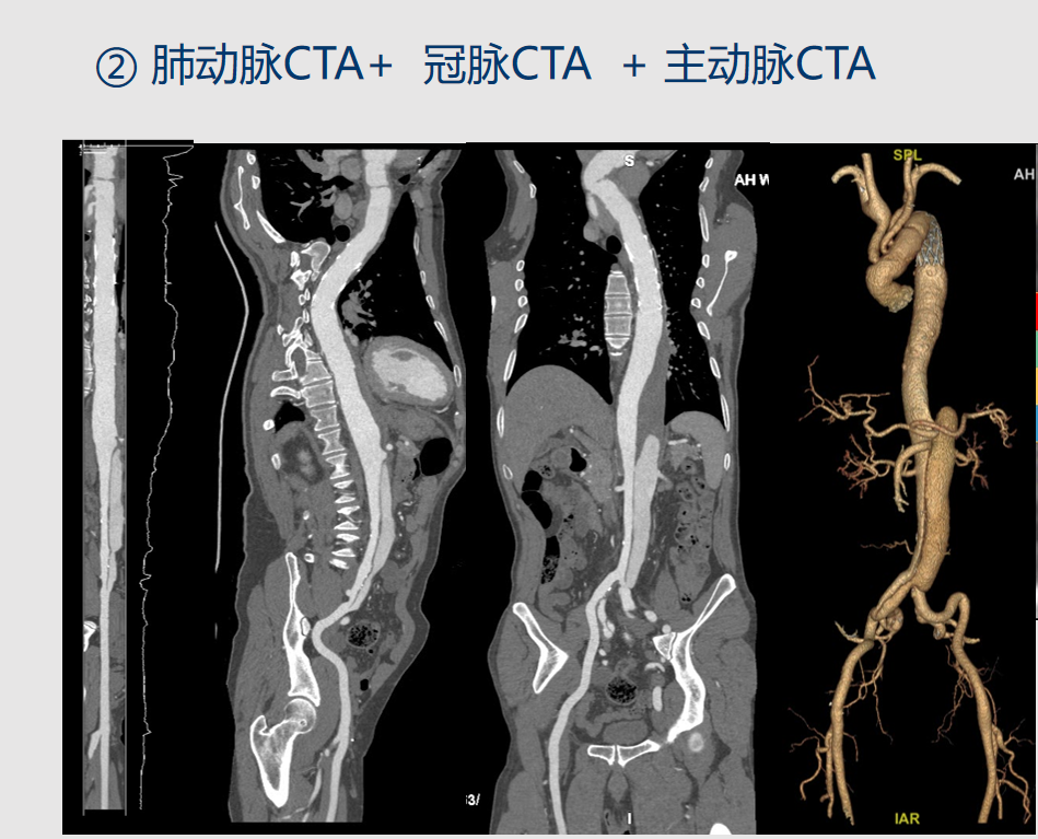 ge的ct有哪些型号影像科│引进GE Revolution 256排高端CT_https://www.jmylbn.com_新闻资讯_第12张