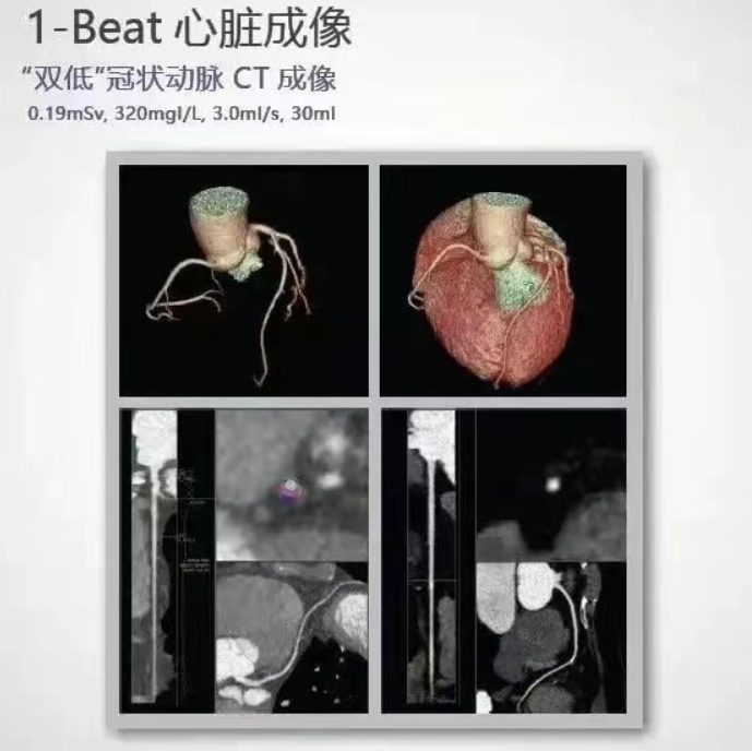 ge的ct有哪些型号影像科│引进GE Revolution 256排高端CT_https://www.jmylbn.com_新闻资讯_第10张