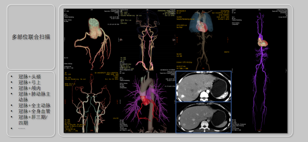 ge的ct有哪些型号影像科│引进GE Revolution 256排高端CT_https://www.jmylbn.com_新闻资讯_第14张