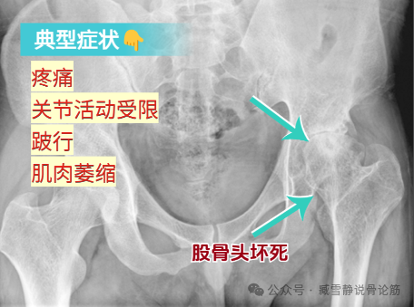 ​2 味药治好股骨头坏死