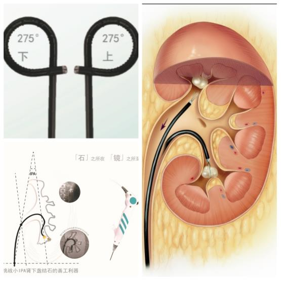 什么是输尿管镜输尿管软镜——微创治疗上尿路结石之“利器”_https://www.jmylbn.com_新闻资讯_第5张
