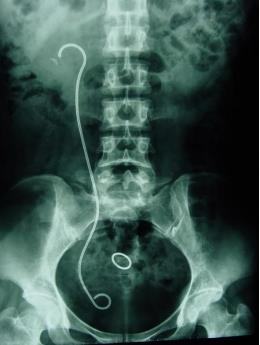 什么是输尿管镜输尿管软镜——微创治疗上尿路结石之“利器”_https://www.jmylbn.com_新闻资讯_第9张