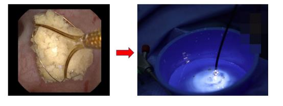 什么是输尿管镜输尿管软镜——微创治疗上尿路结石之“利器”_https://www.jmylbn.com_新闻资讯_第7张