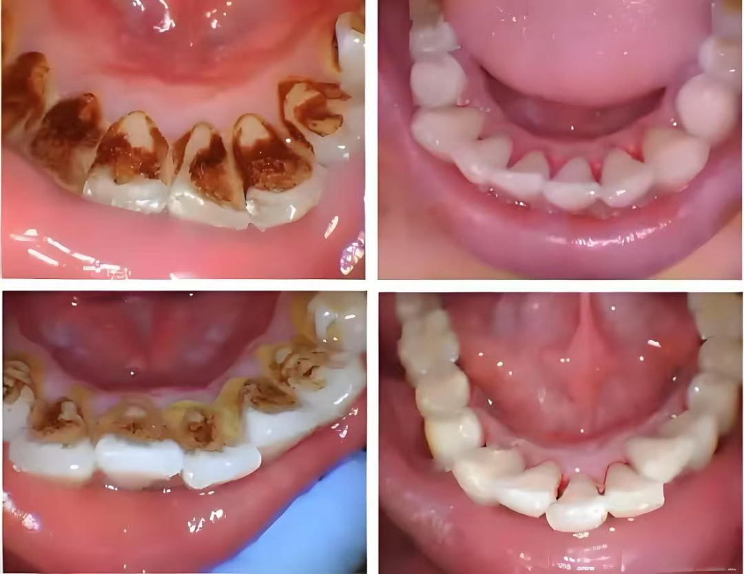 牙周治疗仪怎么做牙周超声喷砂牙周治疗仪，让您的牙齿更白更亮_https://www.jmylbn.com_新闻资讯_第14张