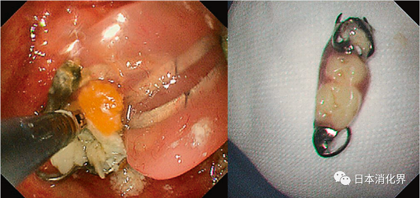 内镜异物钳有哪些内镜异物取出术：自制“好帮手”工具_https://www.jmylbn.com_新闻资讯_第4张