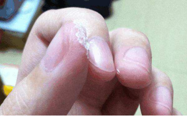 什么是缝线胶神奇的“医用胶水”_https://www.jmylbn.com_新闻资讯_第7张