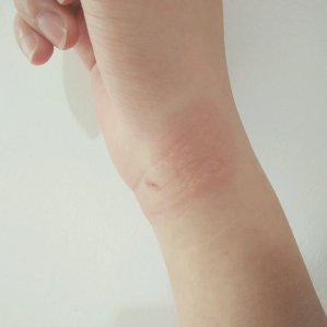 什么是缝线胶神奇的“医用胶水”_https://www.jmylbn.com_新闻资讯_第6张