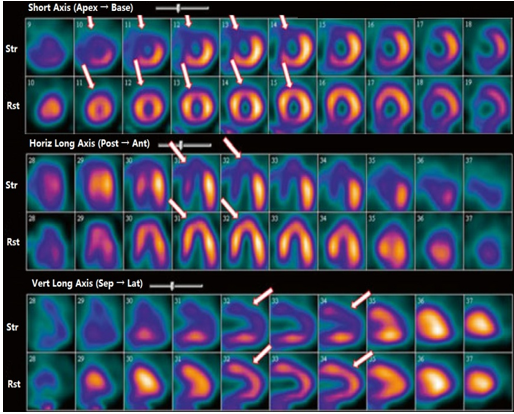 d-spect怎么检查SPECT／CT科普 ｜ 核医学不是 “可怕的核”！从检查到治疗，这些精准利器帮你对抗疾病_https://www.jmylbn.com_新闻资讯_第8张