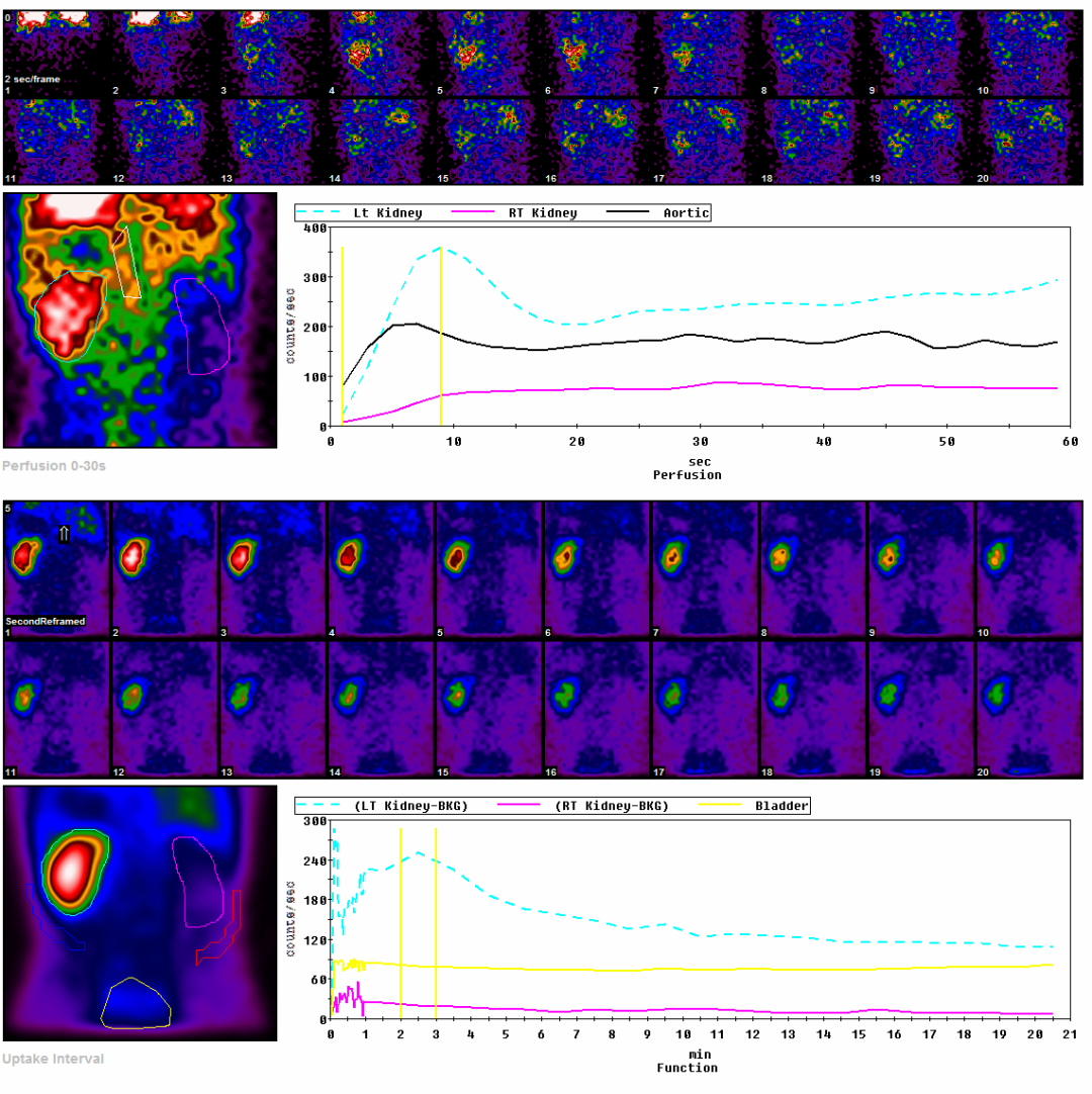 d-spect怎么检查SPECT／CT科普 ｜ 核医学不是 “可怕的核”！从检查到治疗，这些精准利器帮你对抗疾病_https://www.jmylbn.com_新闻资讯_第11张