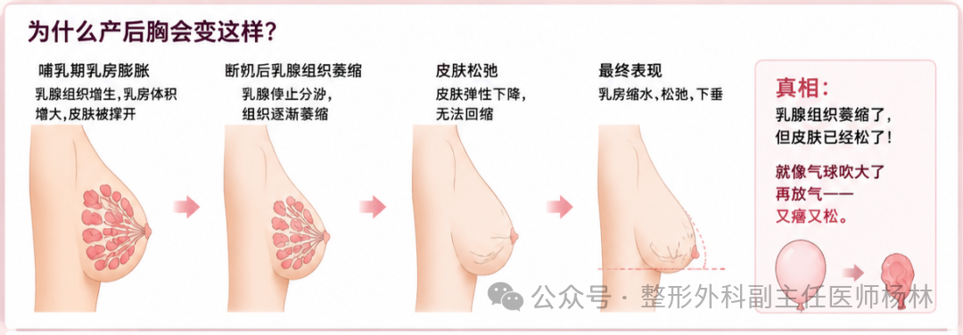 产后胸部变化过程示意图