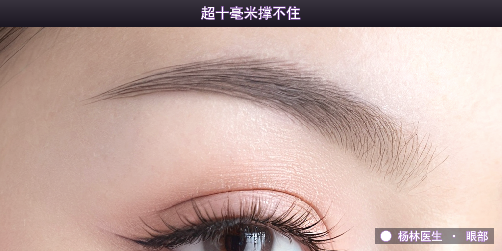 双眼皮超过十毫米为什么显假？医生讲清天生的宽度上限
