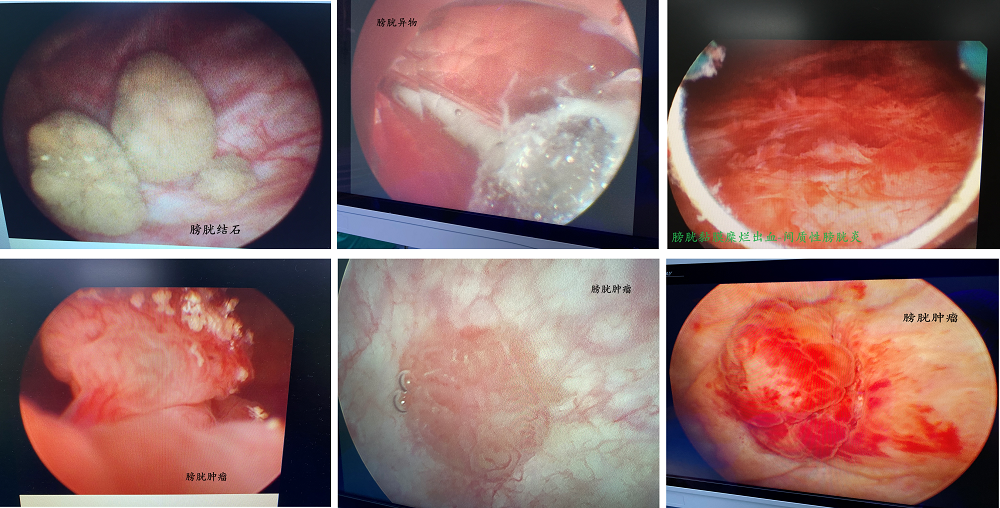 b膀胱镜为什么消毒什么是膀胱镜检查？_https://www.jmylbn.com_新闻资讯_第8张