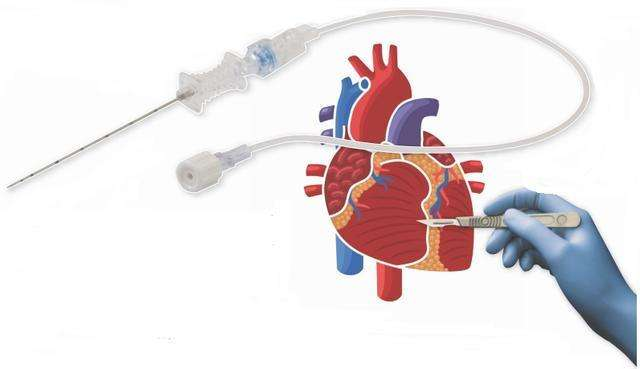 射频什么科【健康科普在附院】什么是心脏射频消融术？_https://www.jmylbn.com_新闻资讯_第7张
