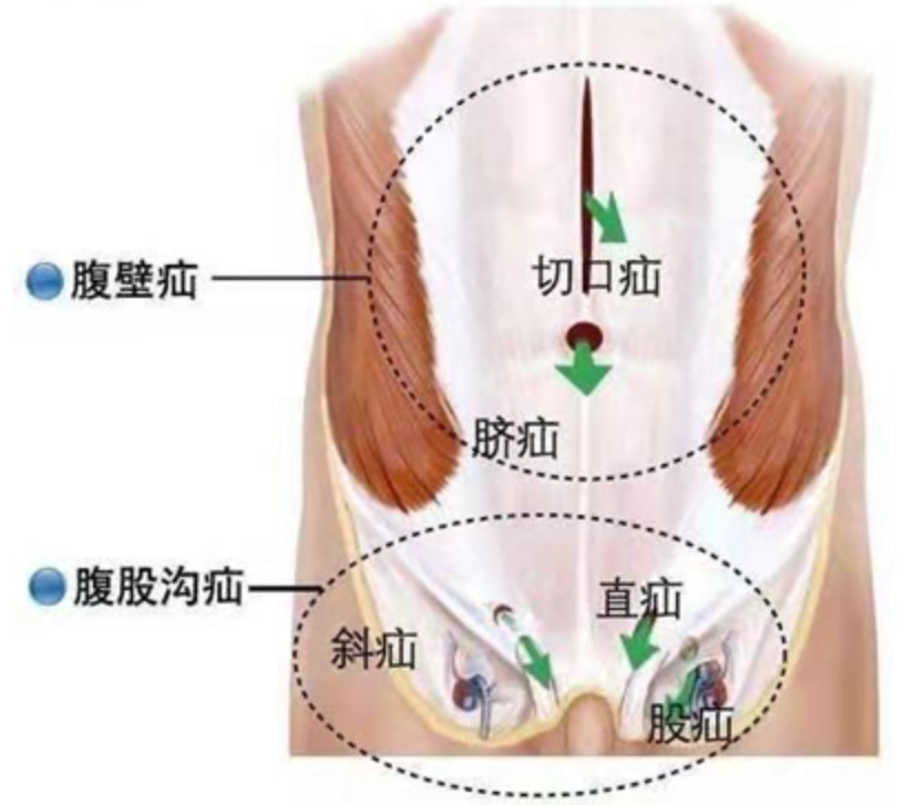 勿以疝小而不為關於疝氣這篇文章都說明白了