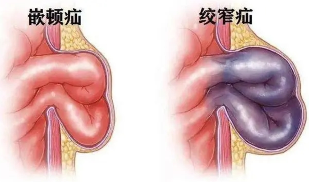 勿以疝小而不為關於疝氣這篇文章都說明白了