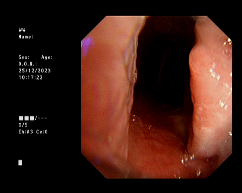 医讯怎么用【五院医讯】关于支气管镜的检查及治疗 ｜ 运用支气管镜技术处理“卡脖子”问题_https://www.jmylbn.com_新闻资讯_第6张