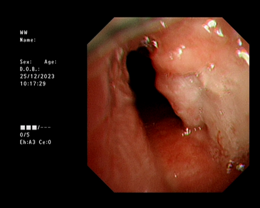 医讯怎么用【五院医讯】关于支气管镜的检查及治疗 ｜ 运用支气管镜技术处理“卡脖子”问题_https://www.jmylbn.com_新闻资讯_第5张
